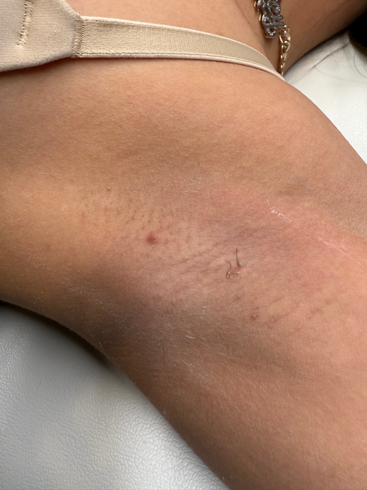718 Underarm Treatment