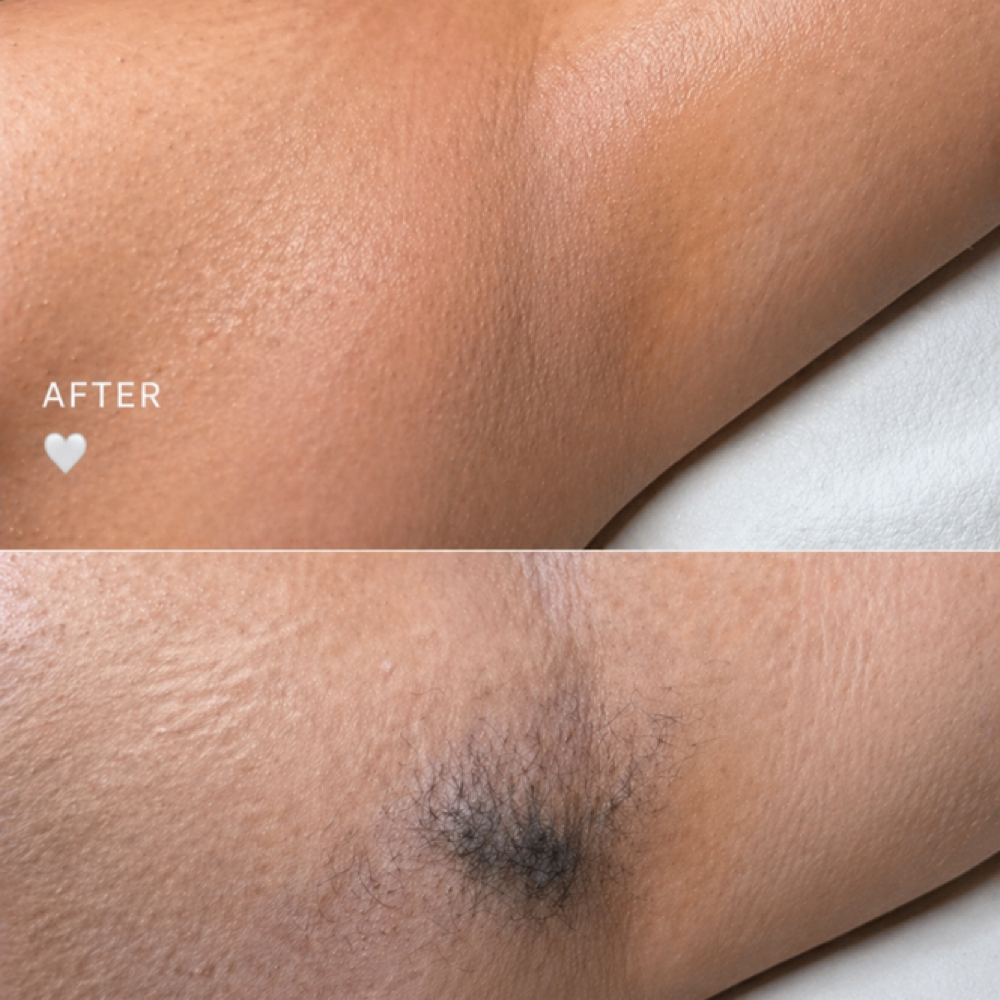 Underarm Wax at Elía Esthetics in Woodhaven, NY