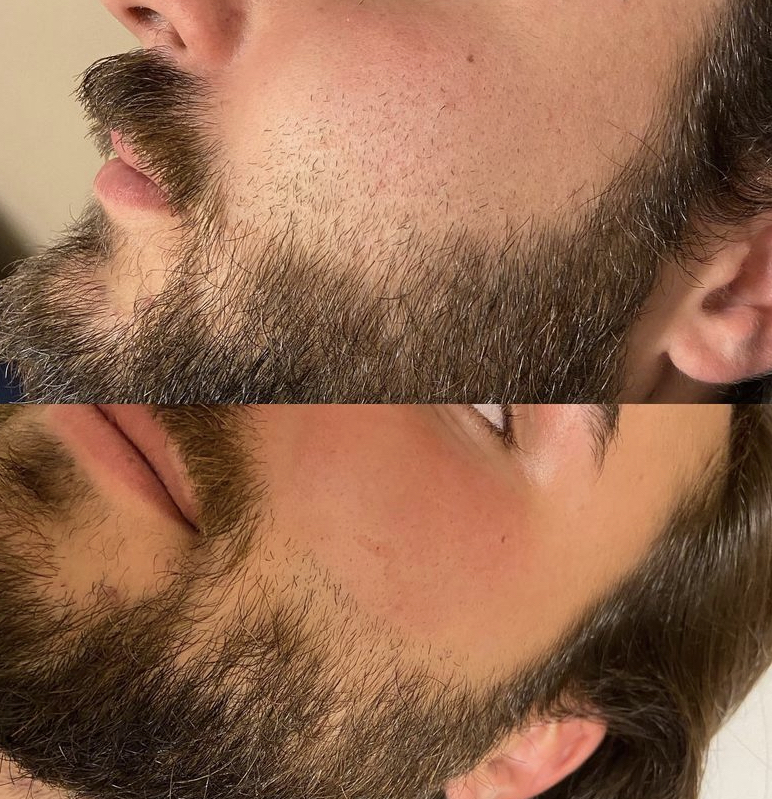 Beard Threading