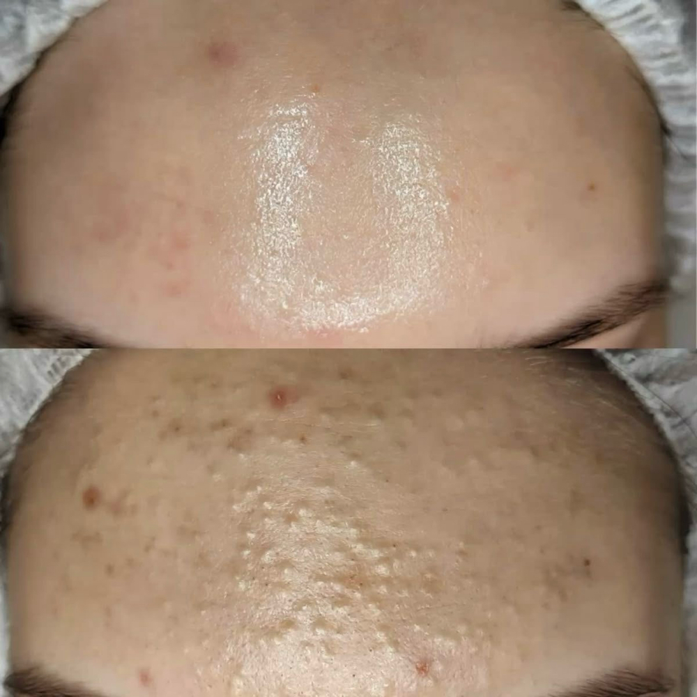 Brightening & Renewal Peel