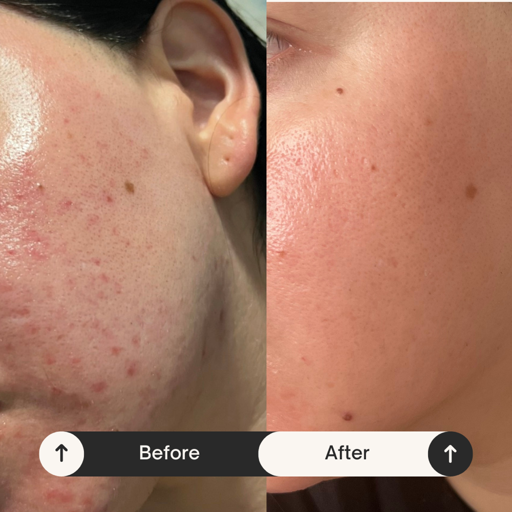 Acne bootcamp consultation / Treat