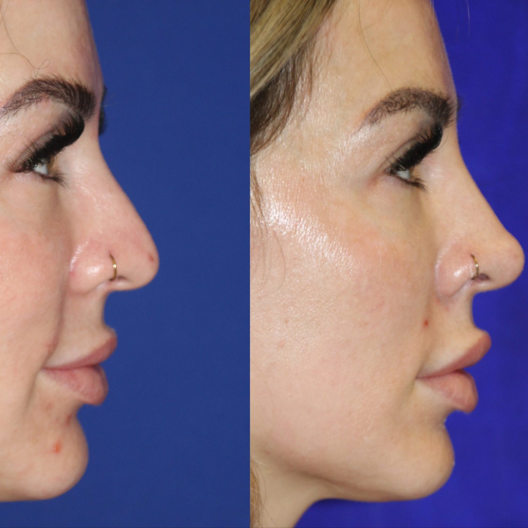Liquid Rhinoplasty at Savage Artistry in melbourne, FL