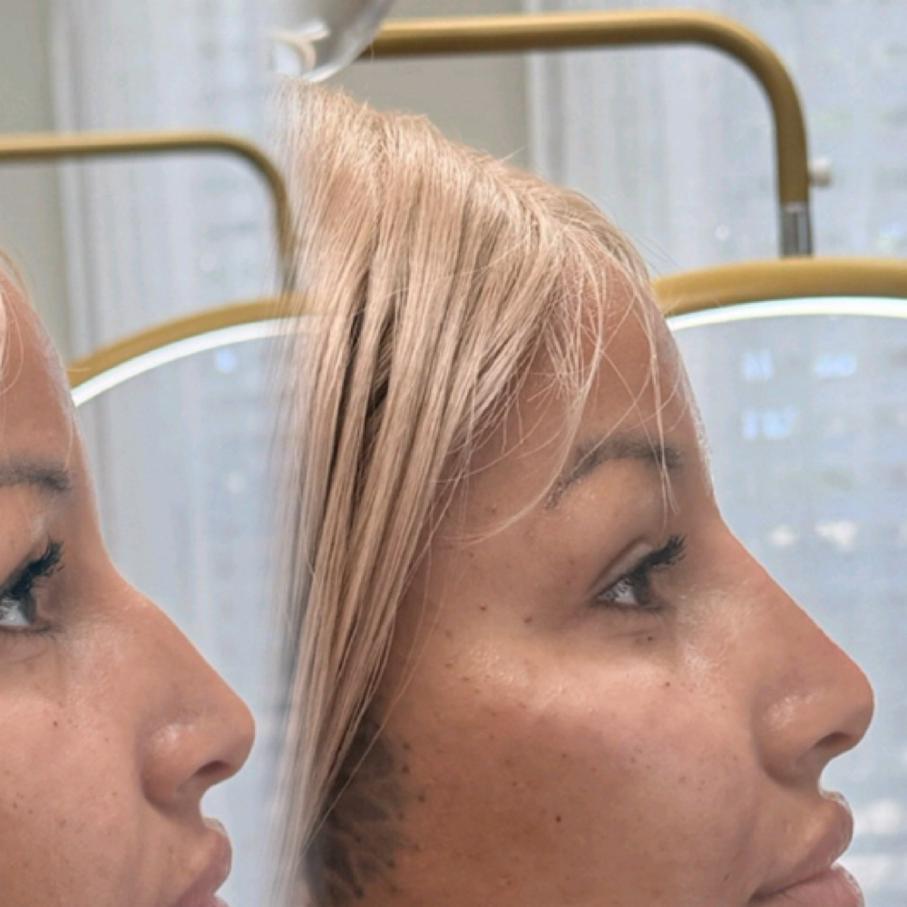 Liquid Rhinoplasty at Savage Artistry in melbourne, FL