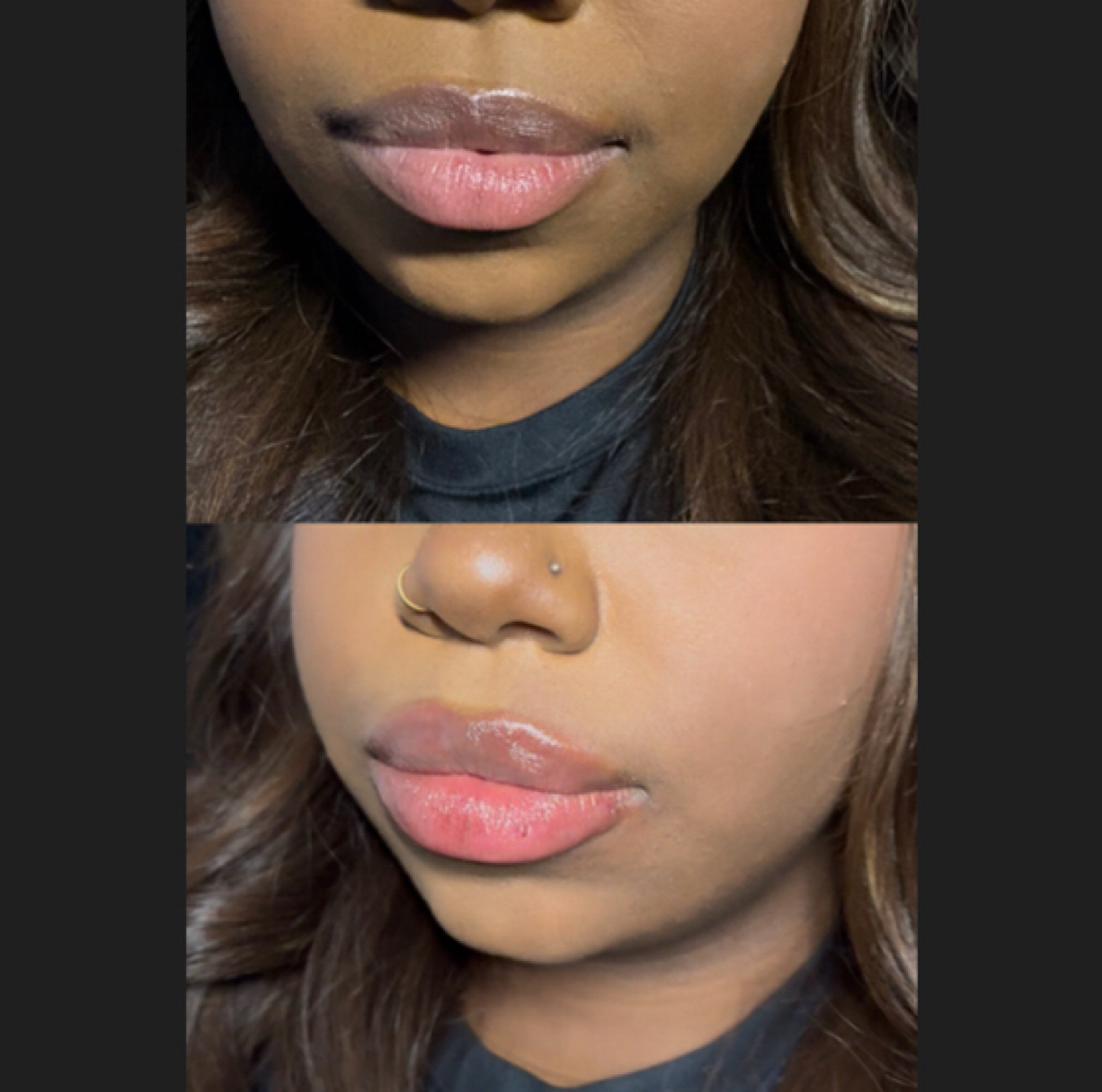 Lip Filler .5ML at Studios Secrets in Dallas, TX