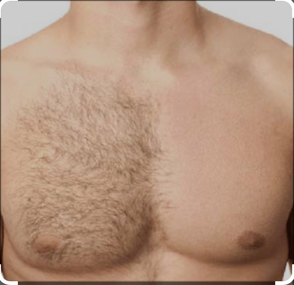 Male Upper Chest Hard Wax