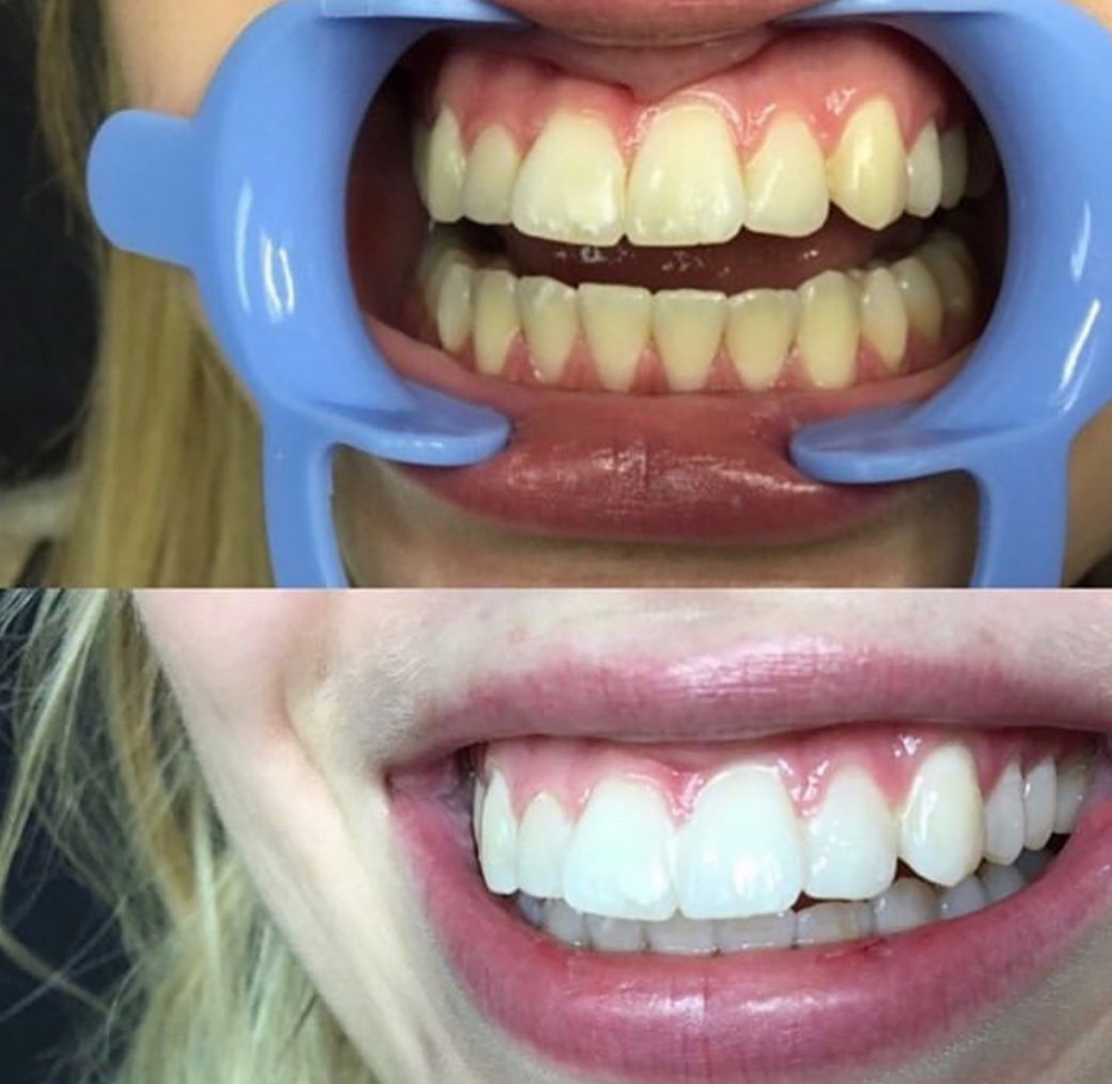 1 Person Laser teeth Whitening