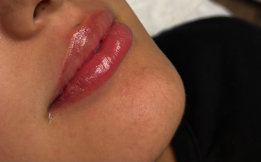 Needleless LipFiller (KS ONLY)