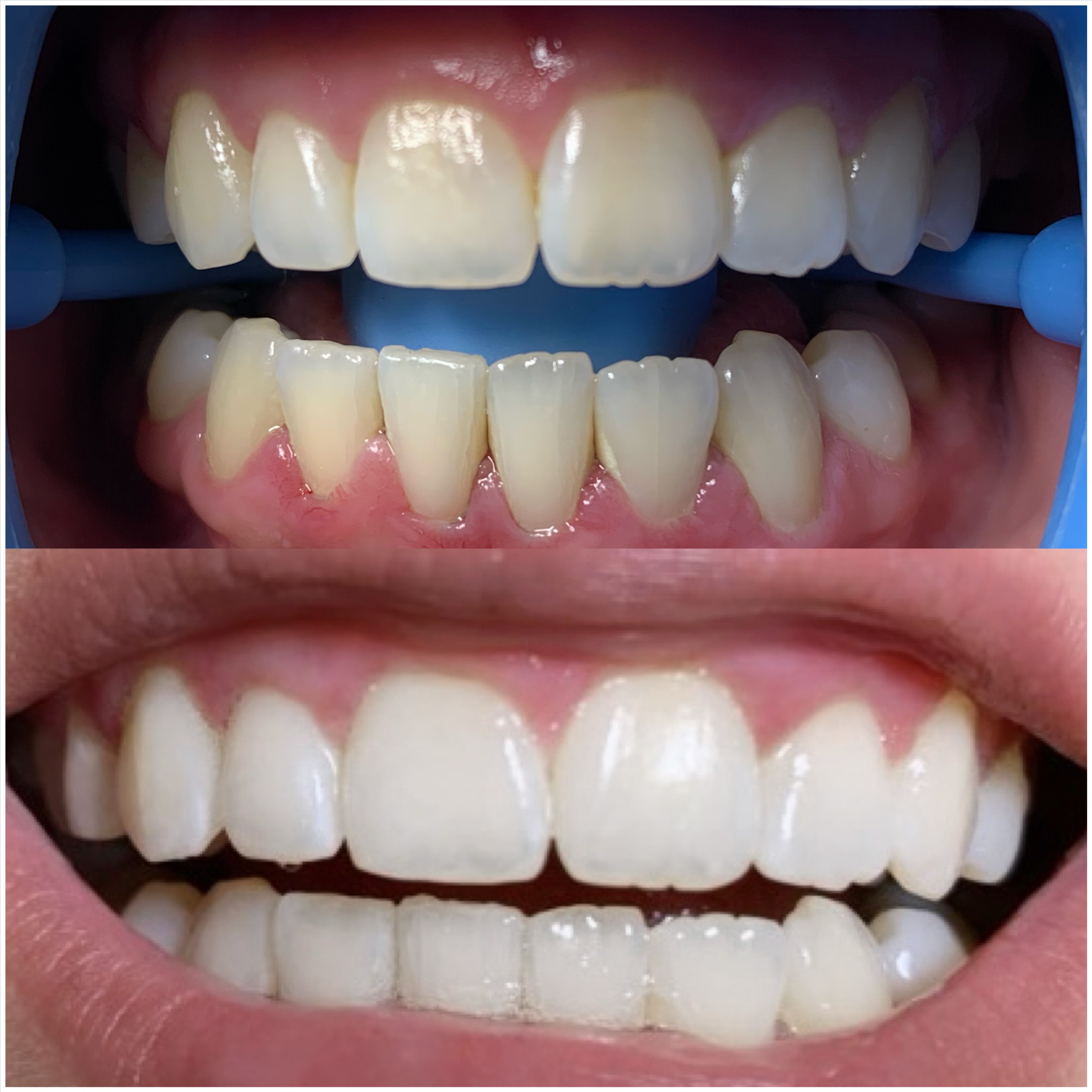 Teeth Whitening: 30 Minute Session
