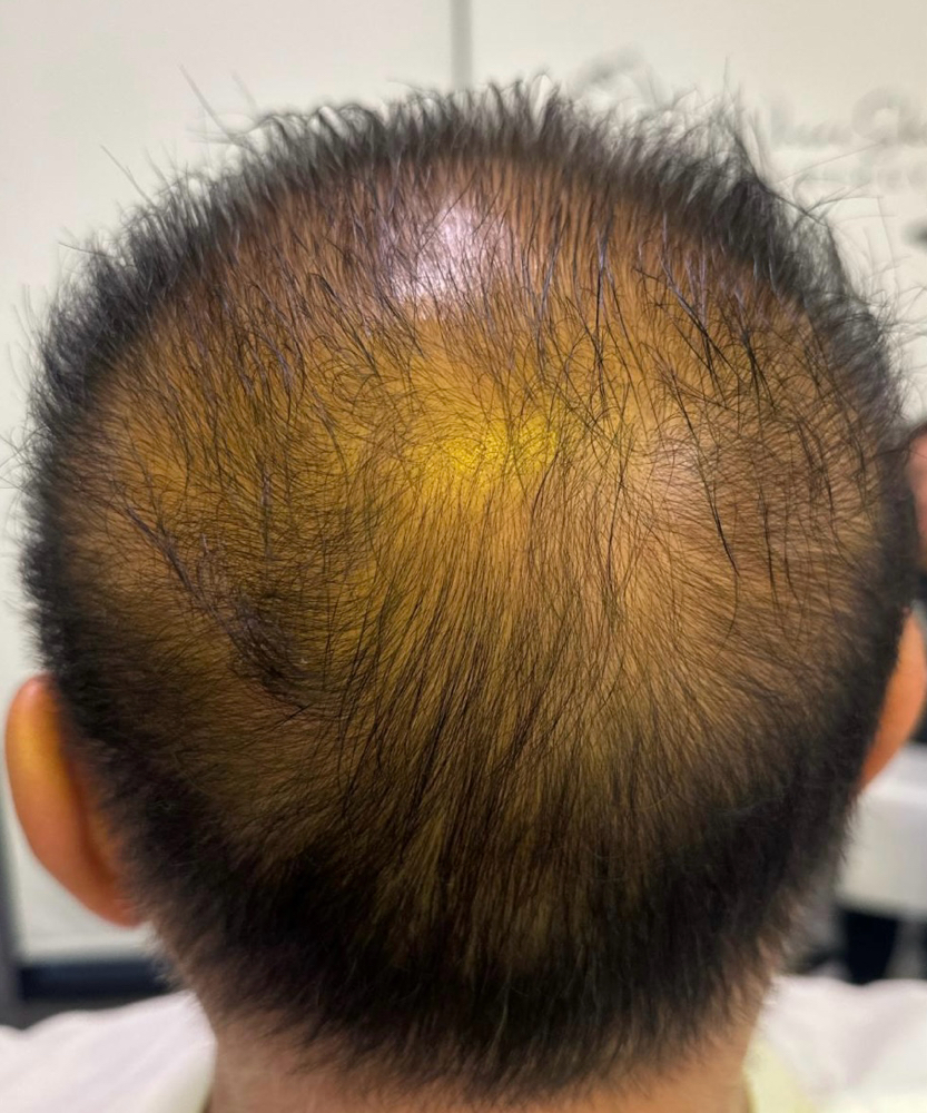 Hair Loss Restoration at Glow N Go Beauty in Los Alamitos, CA