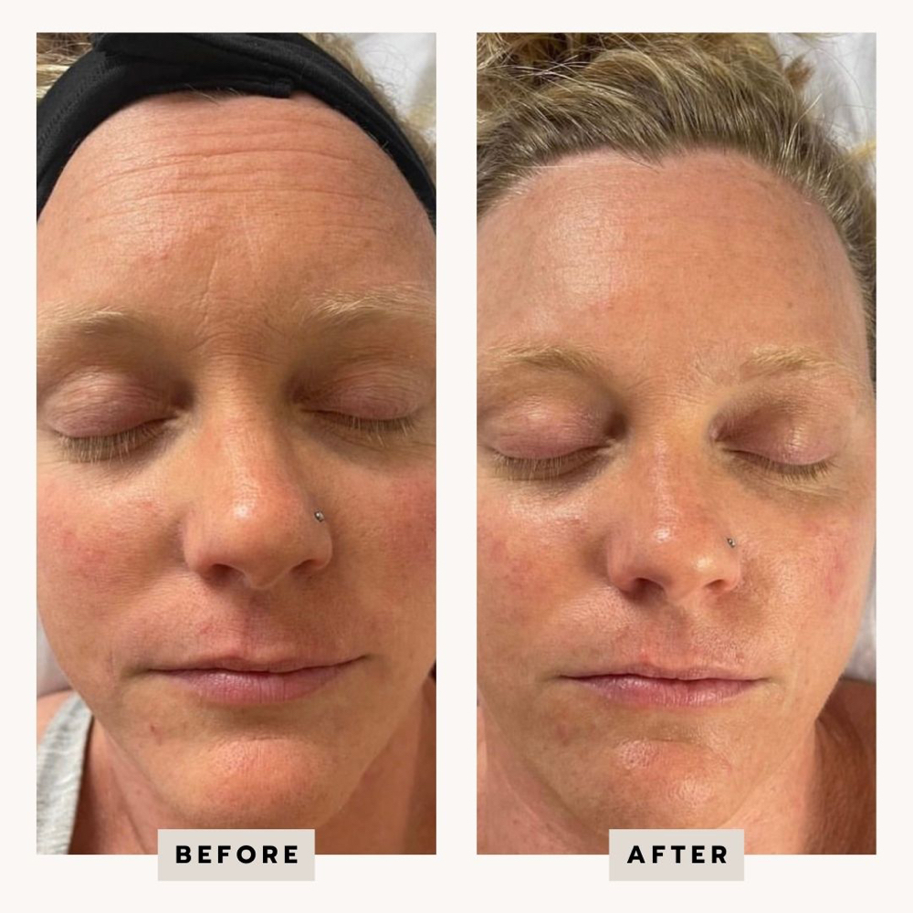 Oxygen RX Facial