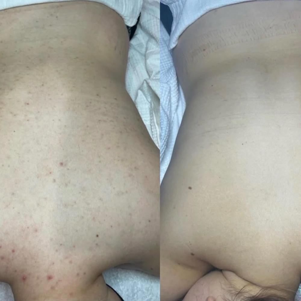 Clarifying Back Peel at Blessed Beauty Aesthetics, LLC in Houston, TX