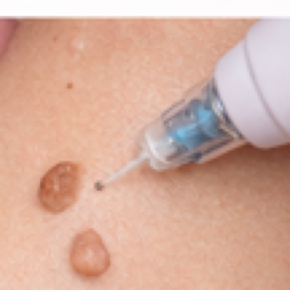 Verrugas 6-15 at Beauty Couture MedSpa in Austin, TX