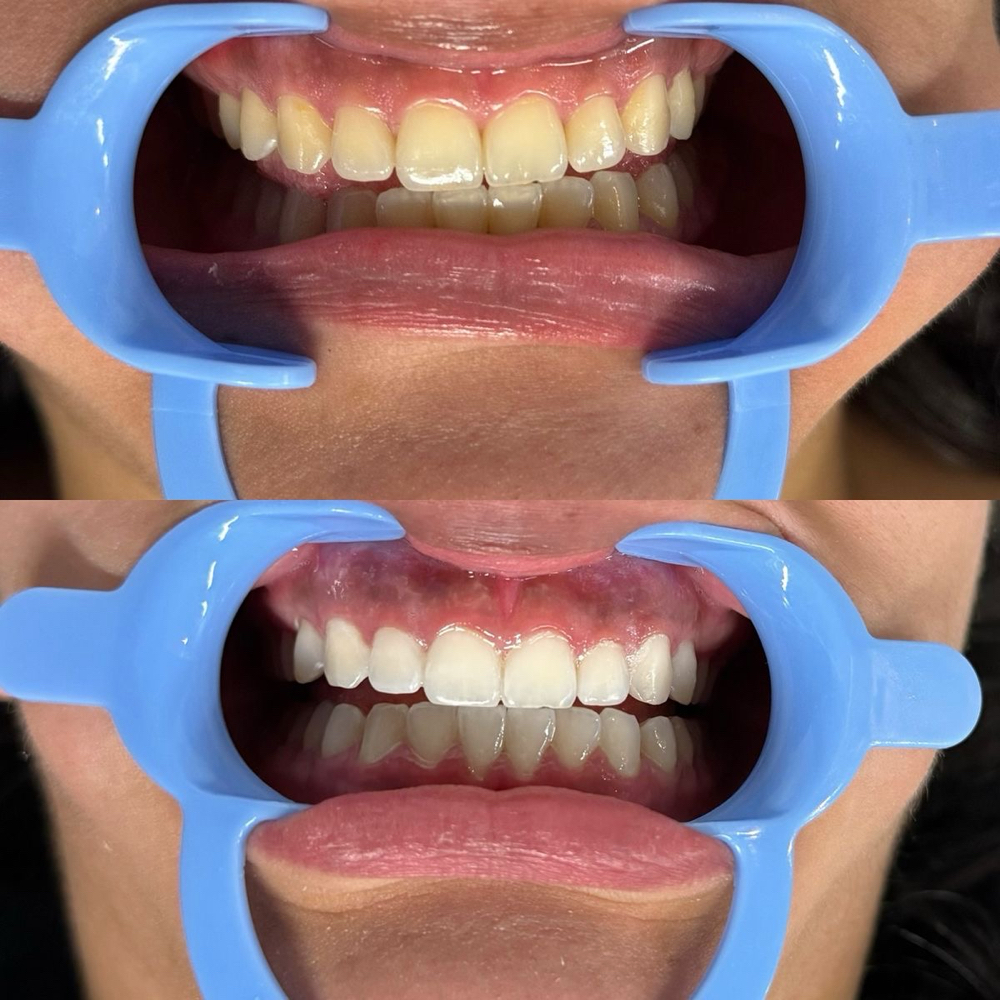 Professional Teeth Whitening at Twin B Beauty and Co. in Canyon, TX