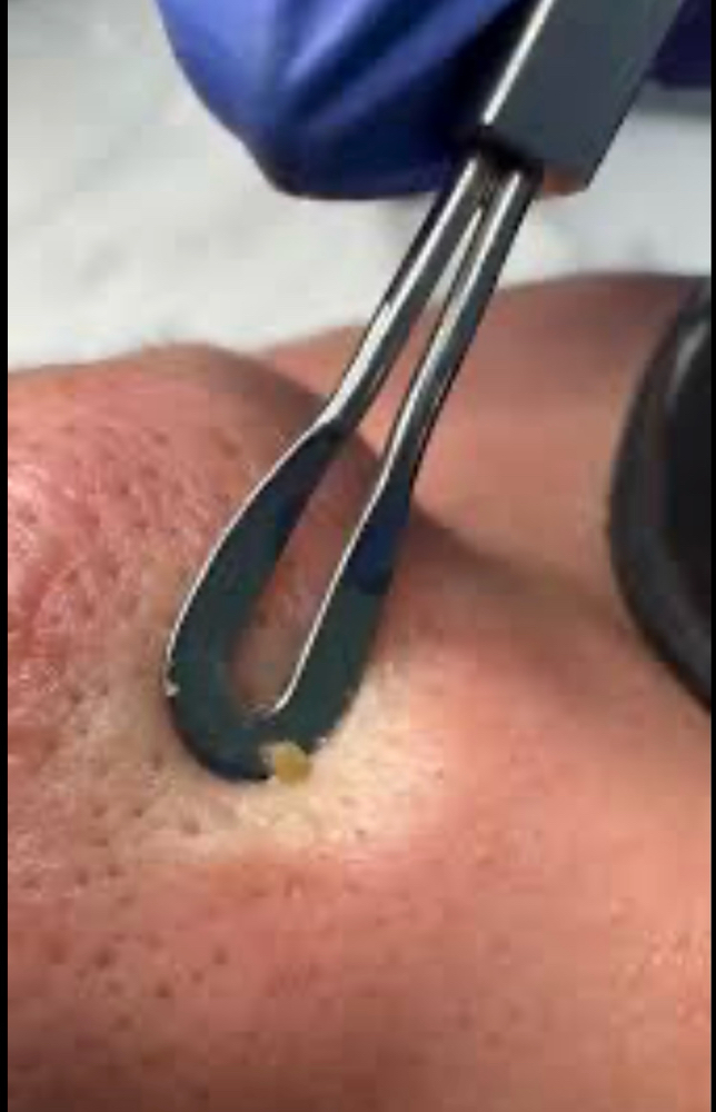 Blackhead Removal Treatment/ Facial at Skintique by lacey in Dayton, OH