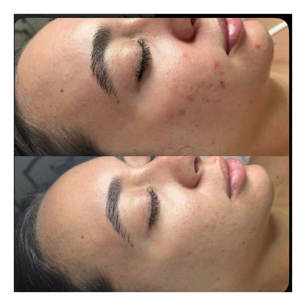 Brightening Mandelic Peel at PureBeauty-Aesthetics in Colorado Springs, CO