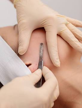 Express Dermaplane
