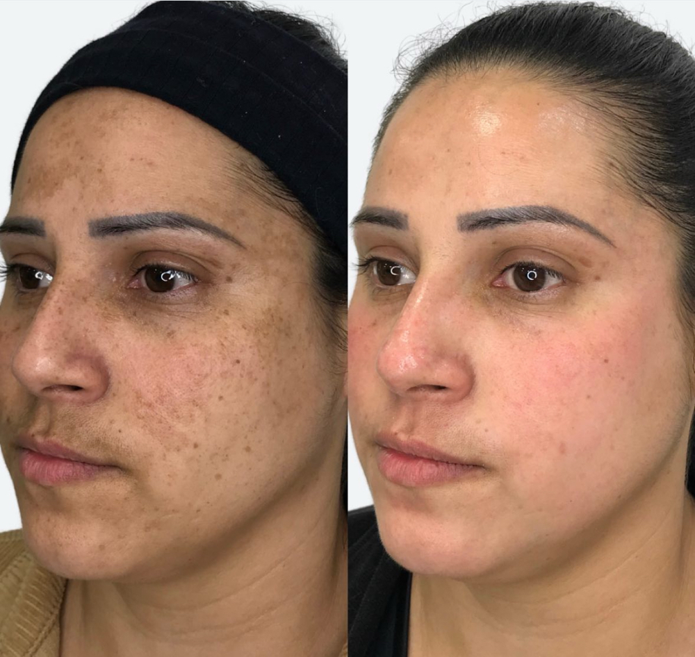 Melasma at Jessica Luchesi Skin Wellness in Elizabeth, NJ