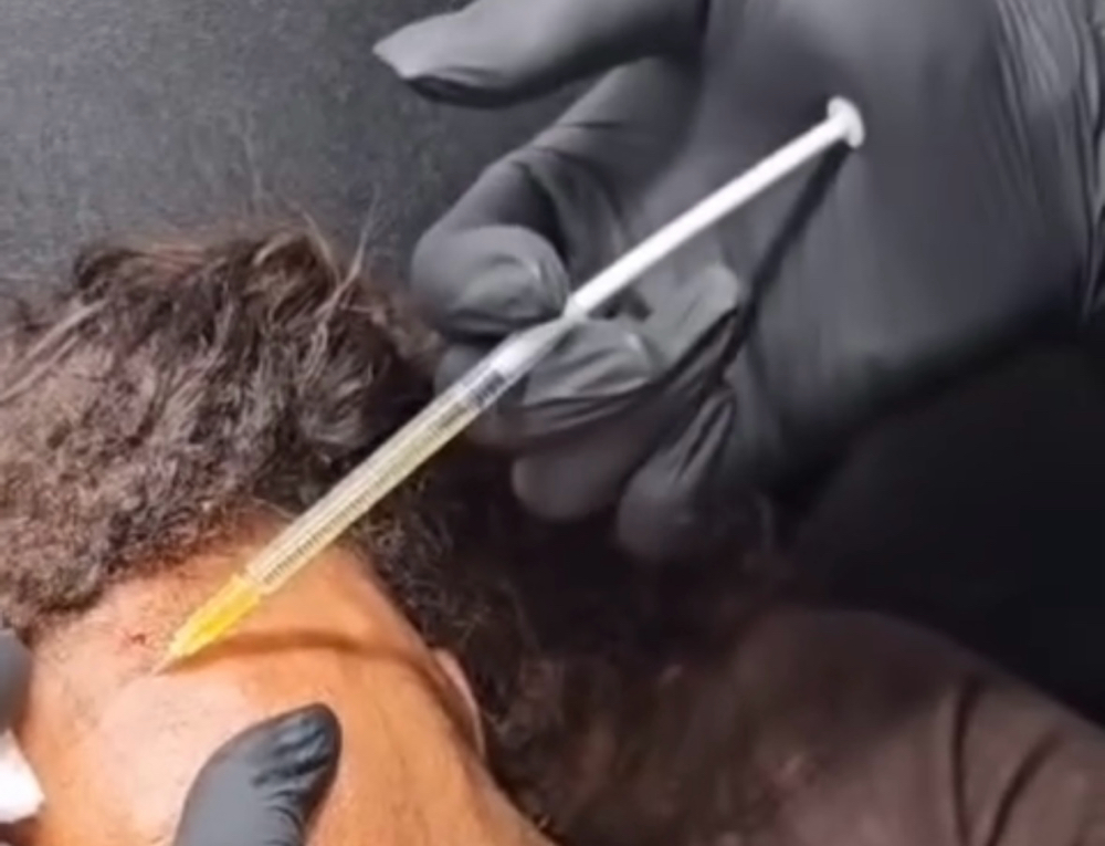 PRF SCALP INJECTIONS/Hair Loss at Juiced by Q in Baldwin, NY