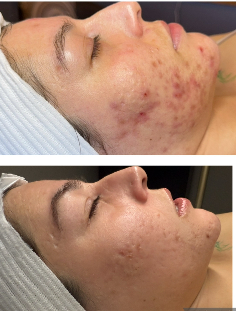 FR Acne Treatment (Current Clients)