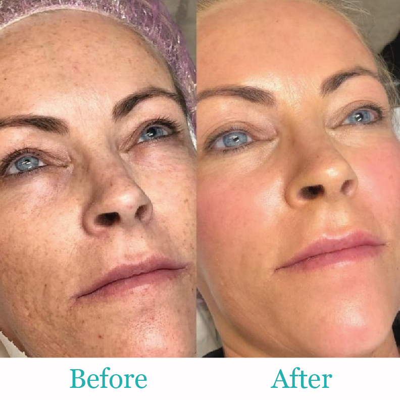 BB Glow Facial