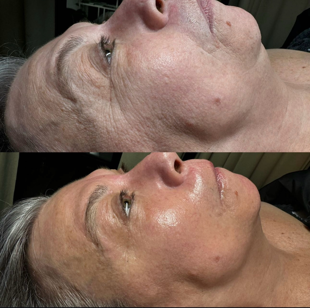 Age Rewind Protein Oxygen Therapy