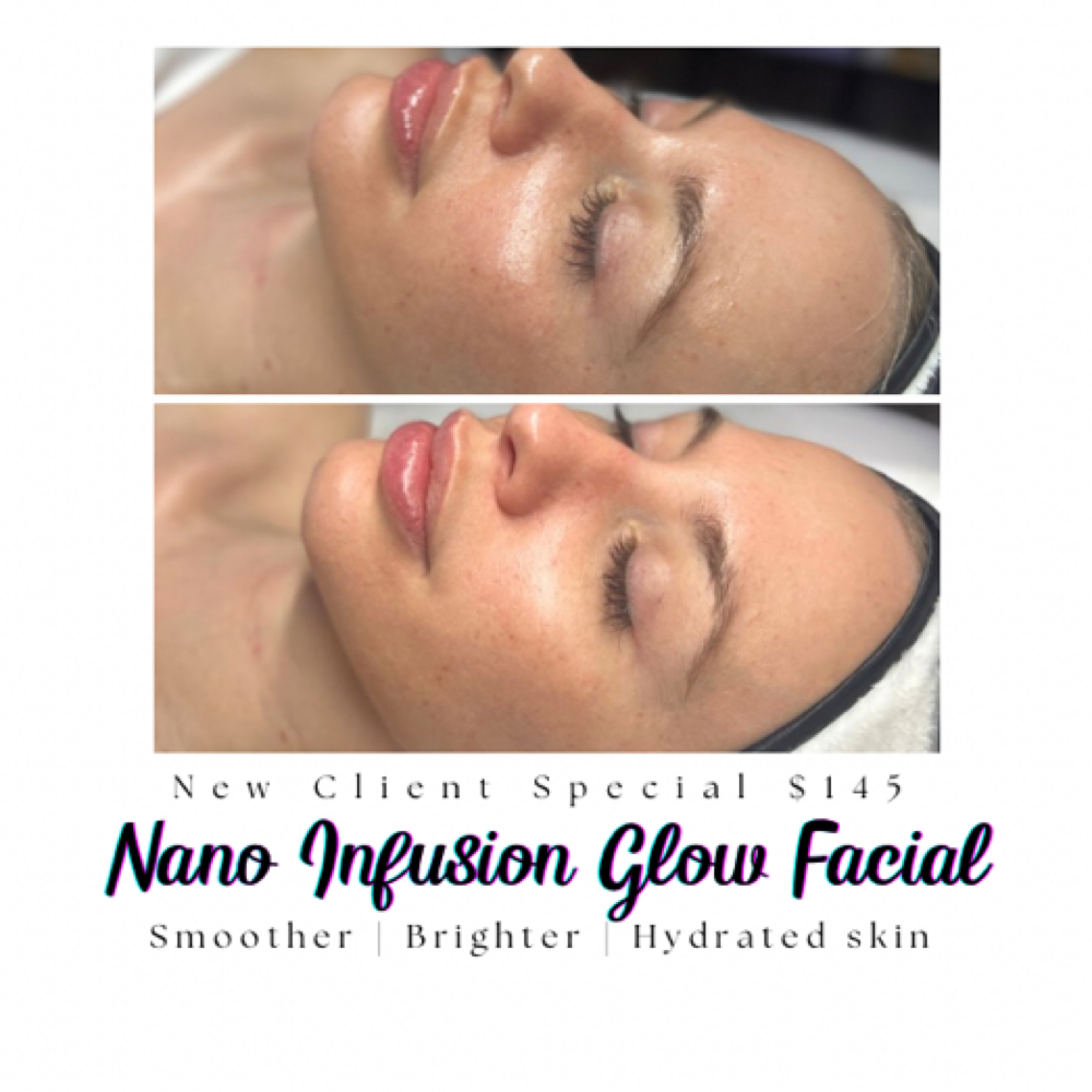 Nano Infusion Glow Facial at Nova Skin Studio in Getzville, NY