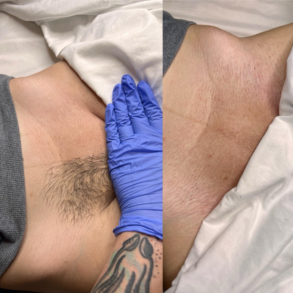 Brazilian at Raine Esthetics in Pendleton, IN