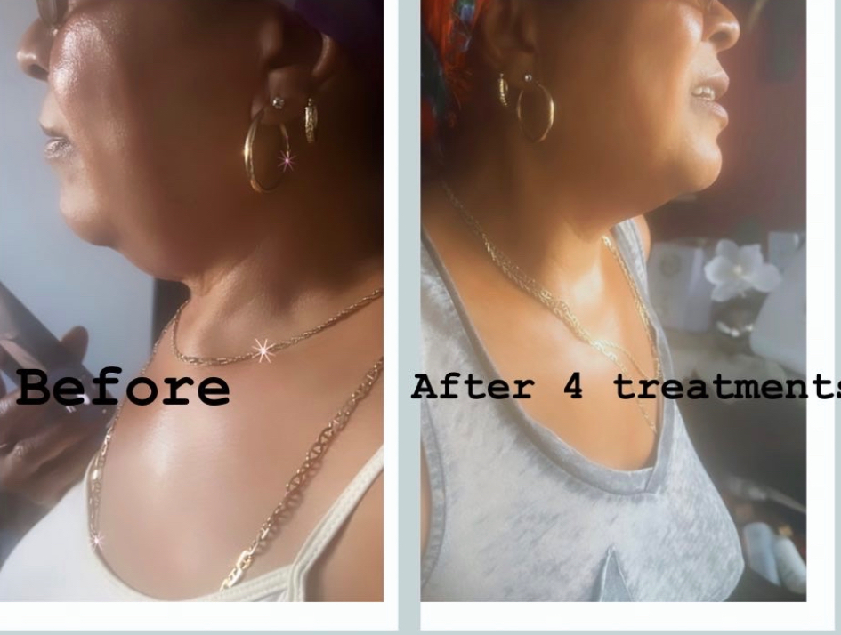 Chin & Jawline Sculpting 6 session at ShapedbyNicolabrowsandbody in Brooklyn, NY