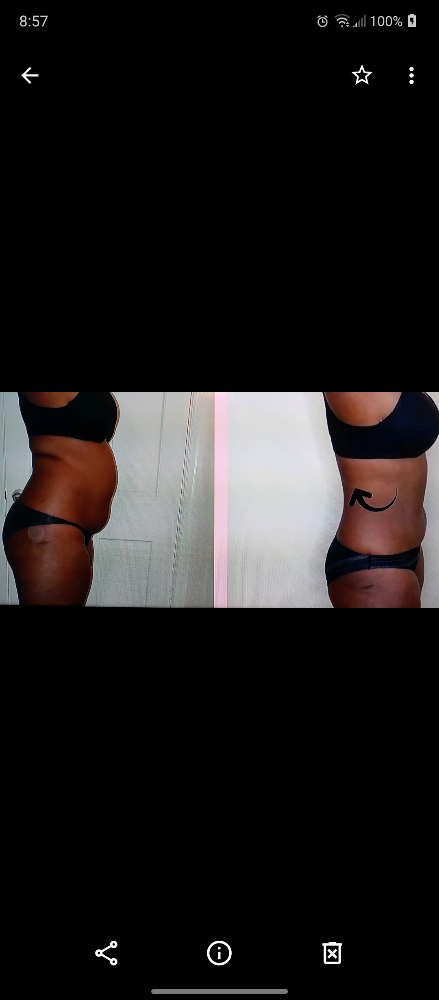 Body Contouring & Laser Lipo