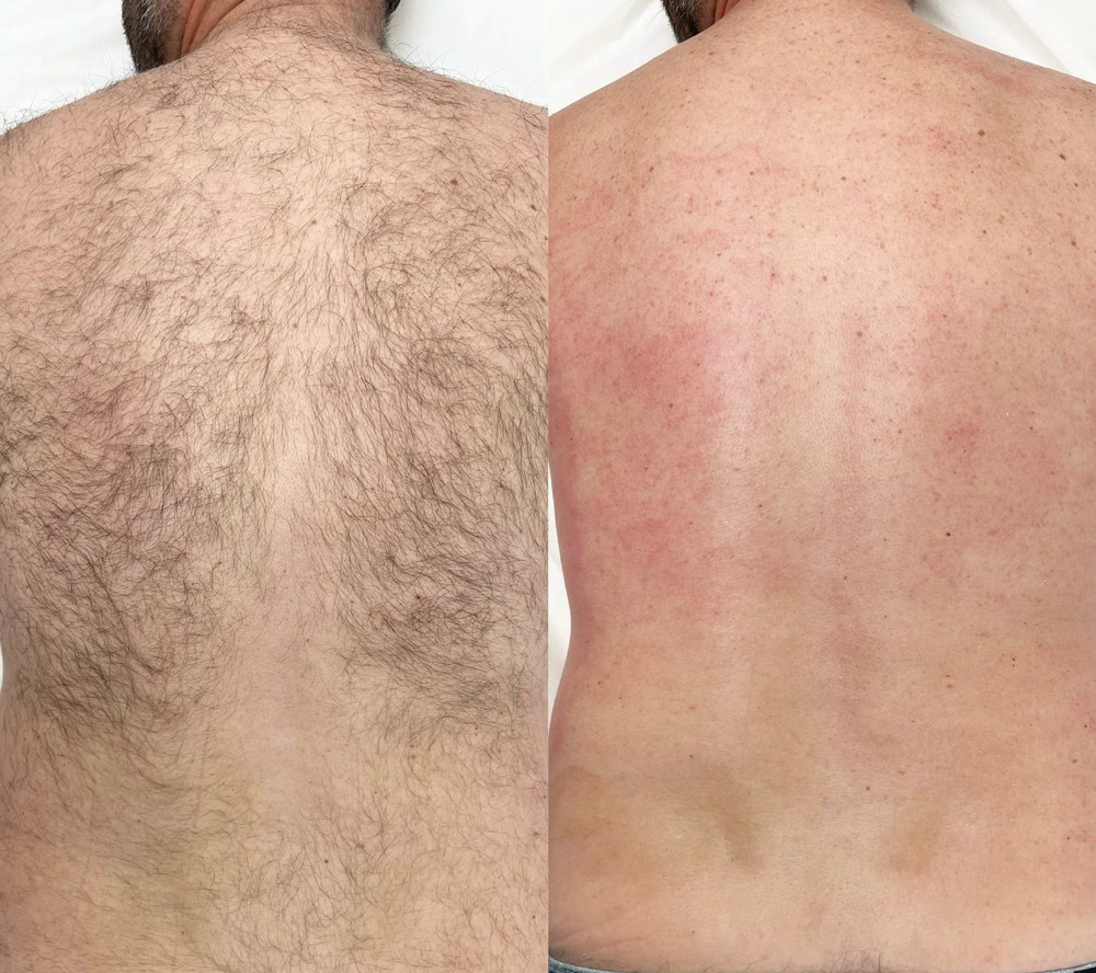 Back Wax at Allure Beauty Studios by Jeila in Abilene, TX