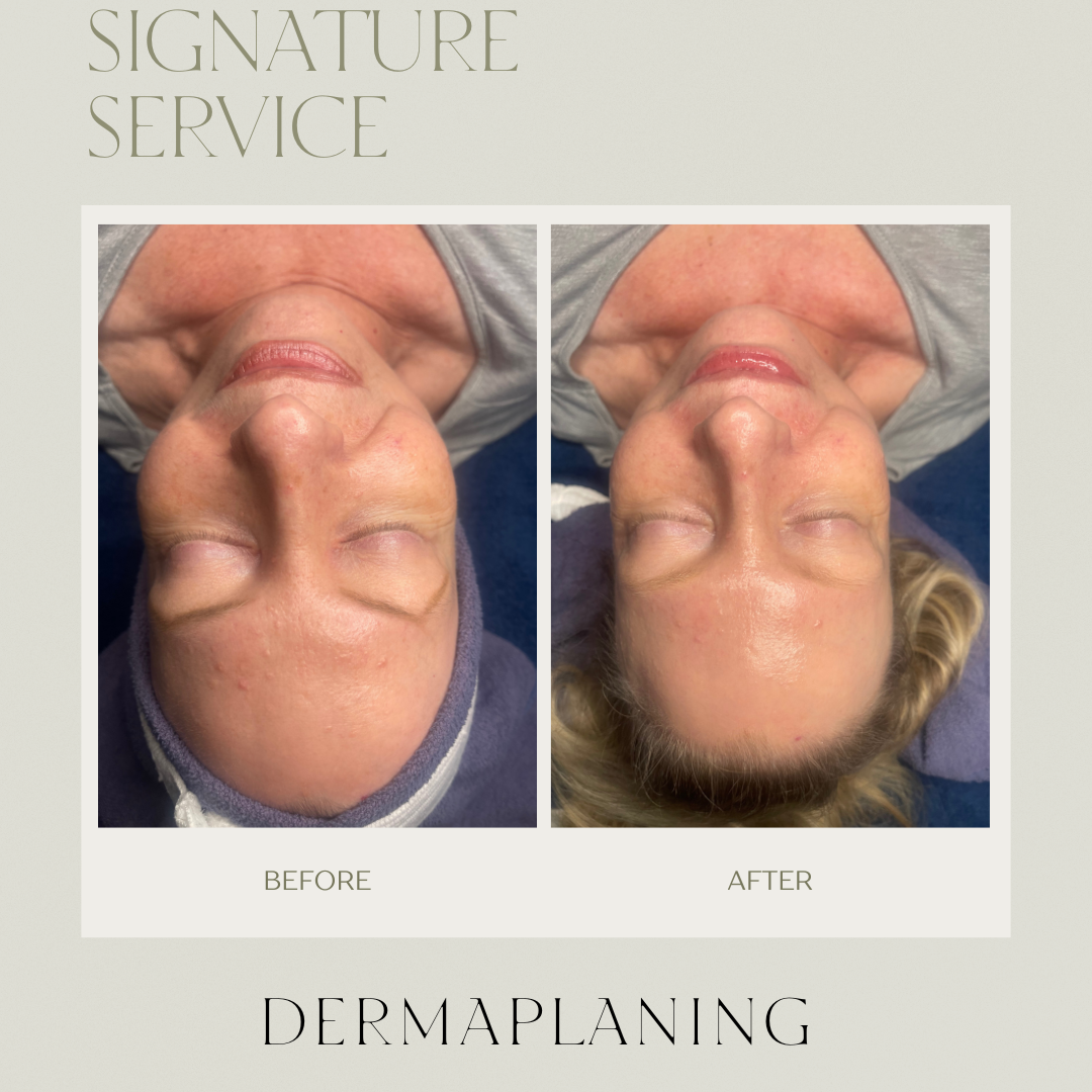 Dermaplaning