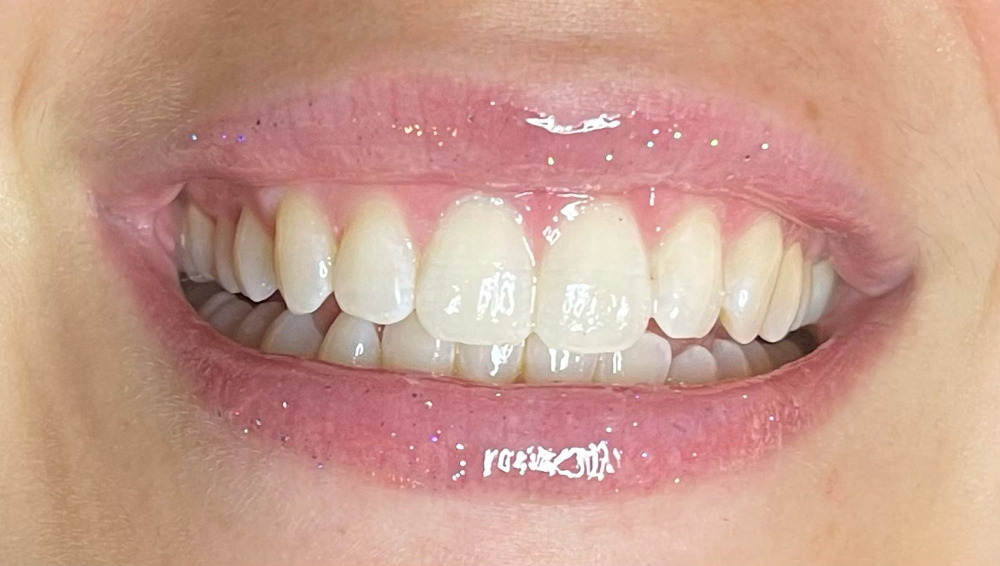 60min Teeth Whitening