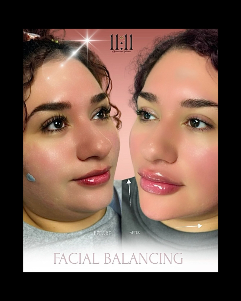 Chin Filler