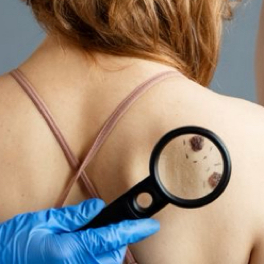Warts Removal at Luxe Aesthetic & Wellness Center in Los Angeles, CA