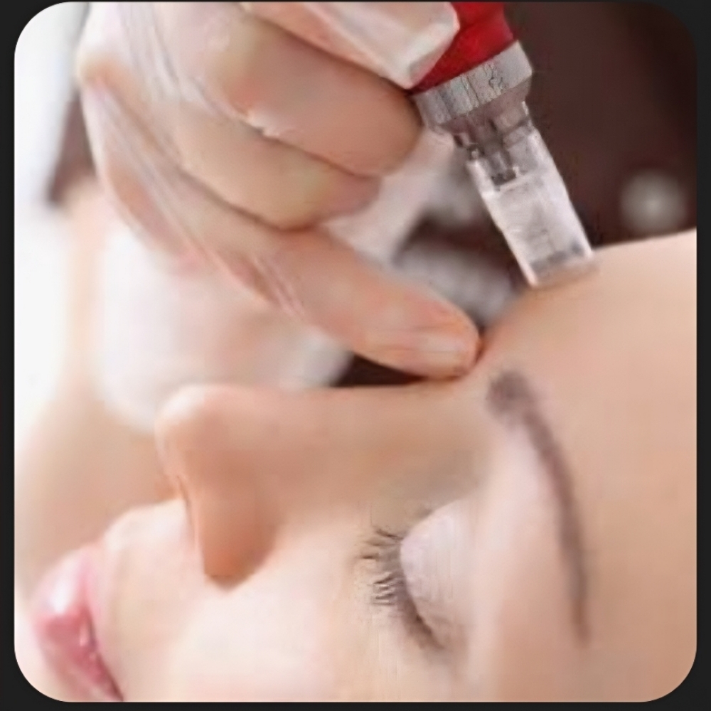 Microneedling at LOOK in San Bernardino, CA