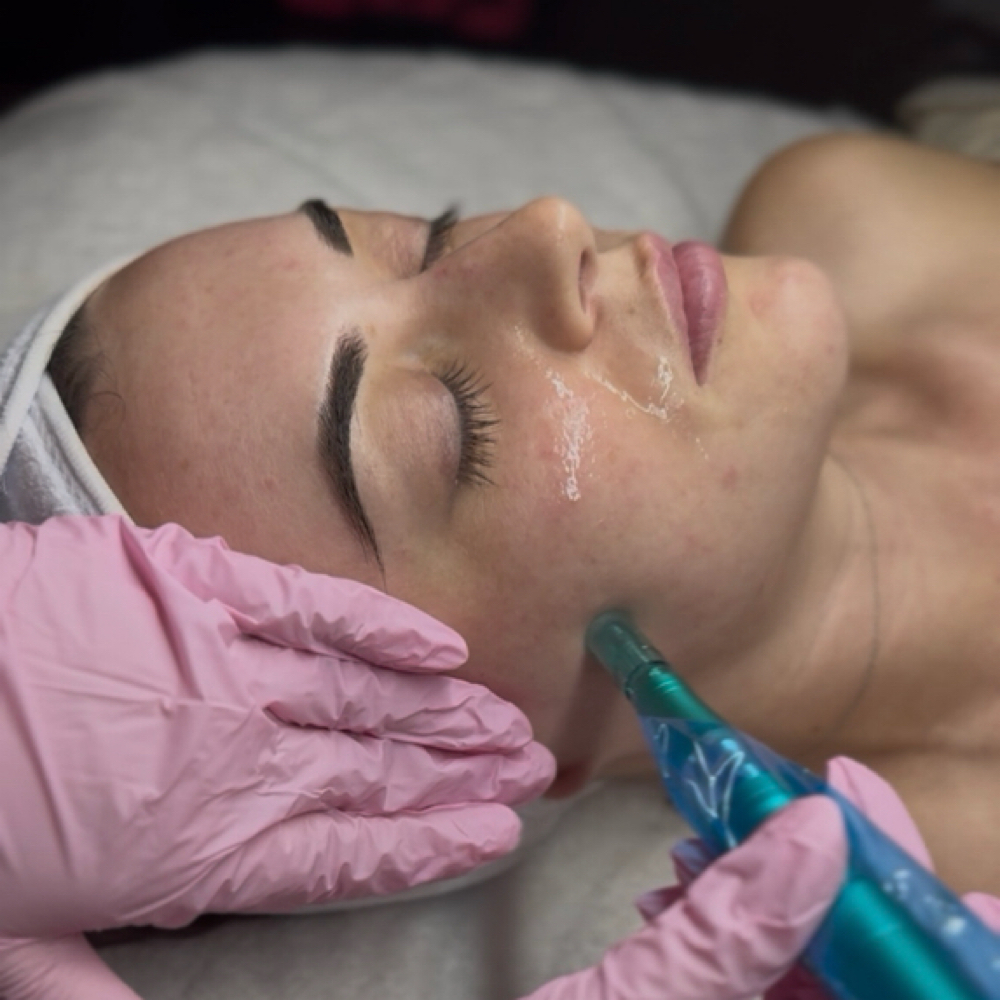 Nanoneedling at Luxe Complexion Aesthetics in Jupiter, FL