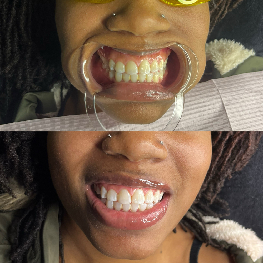 Teeth Whitening