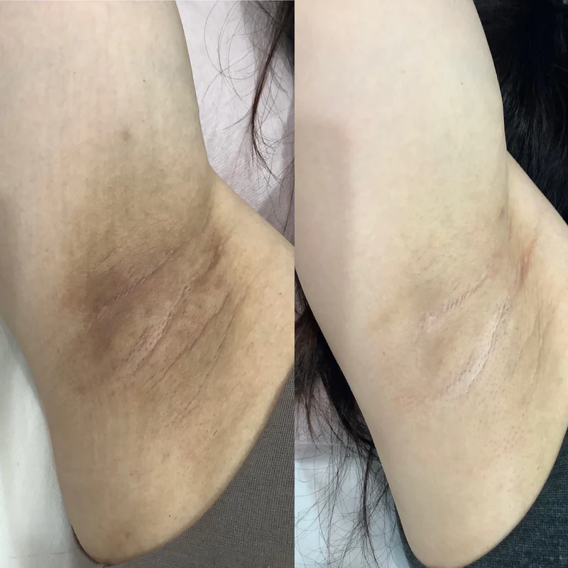 Bleach under arms