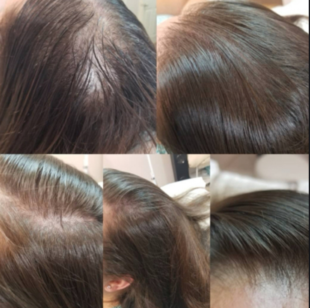 Scalp Micro-pigmentation