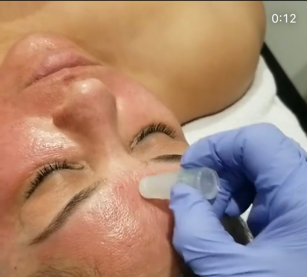 AnteAGE Stem Cell Microneedling