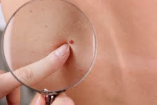 Angioma Removal