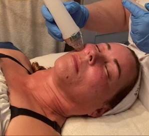 Microneedling