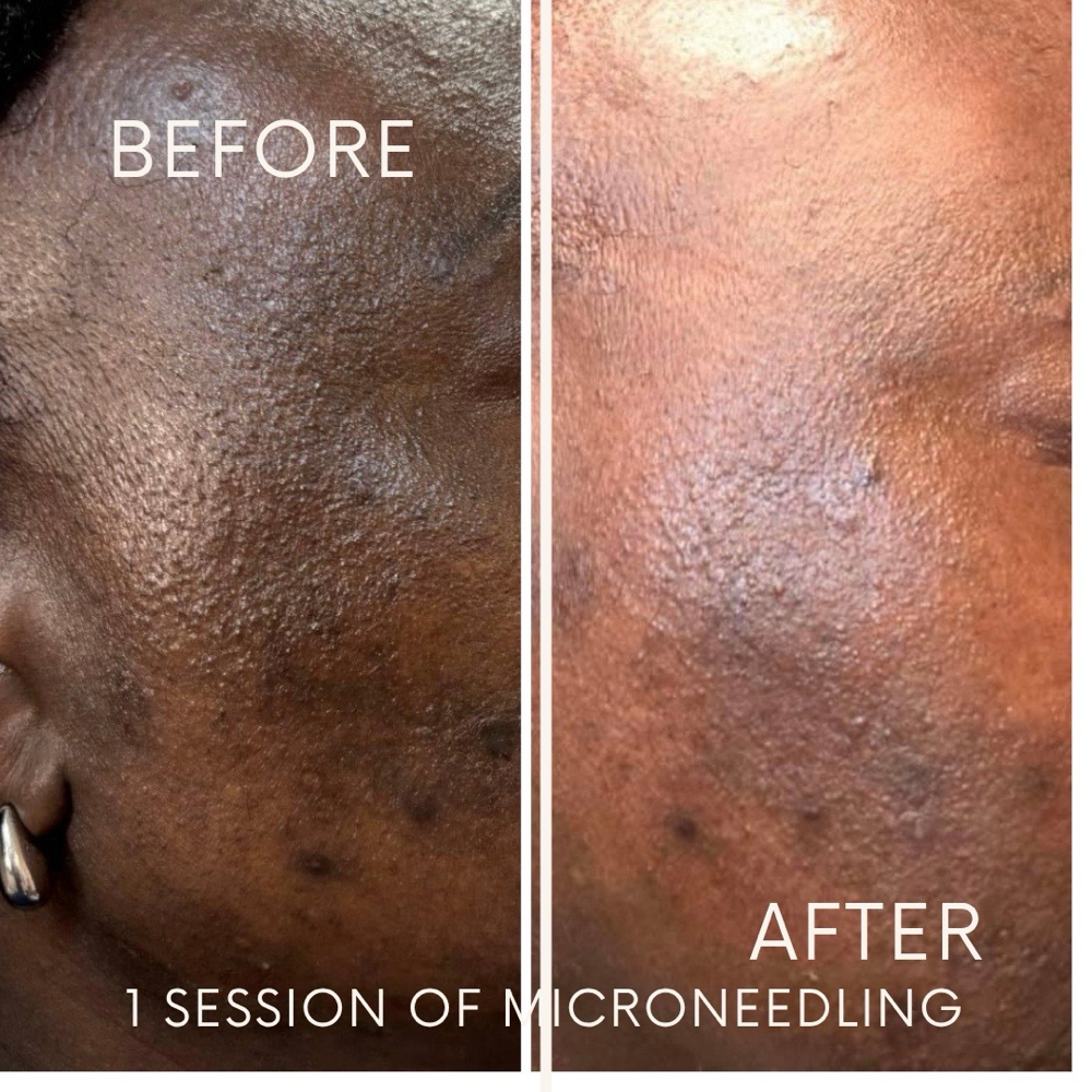 PRP Microneedling at The Beautyful Secret in Shreveport, La., LA
