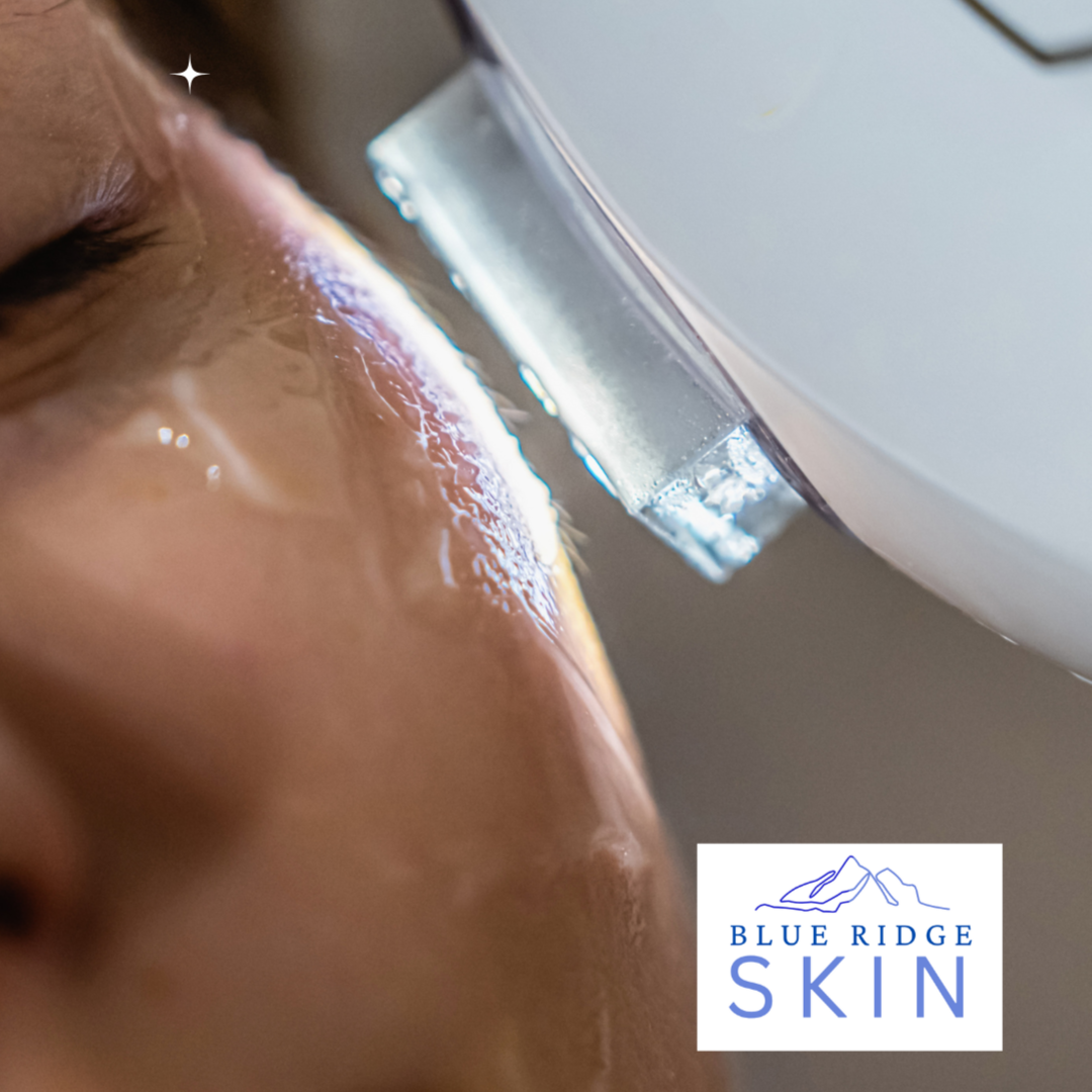 IPL Treatments at Blue Ridge Skin in staunton, VA