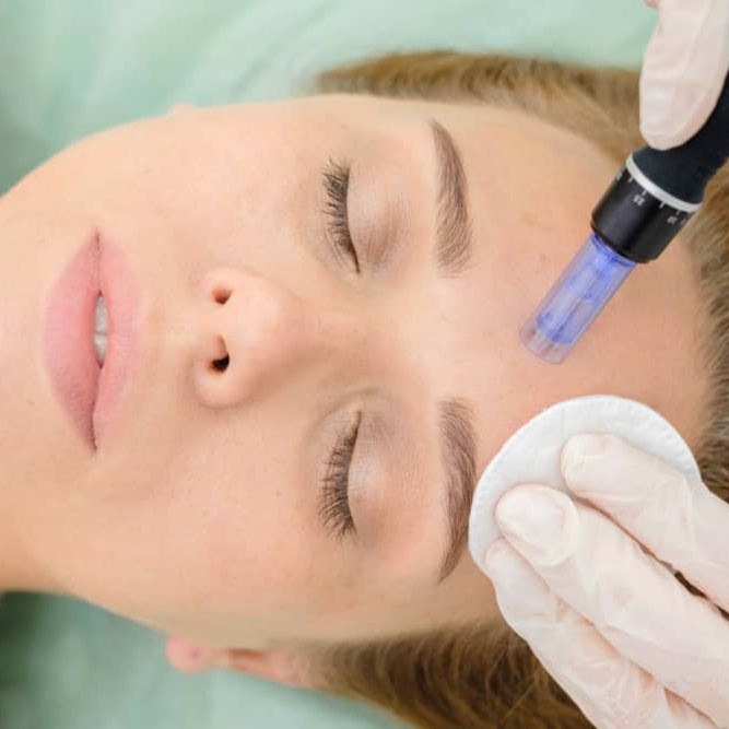 Microneedling Facial - Marcia at Worthy of Wellness LLC in Winter Park, FL