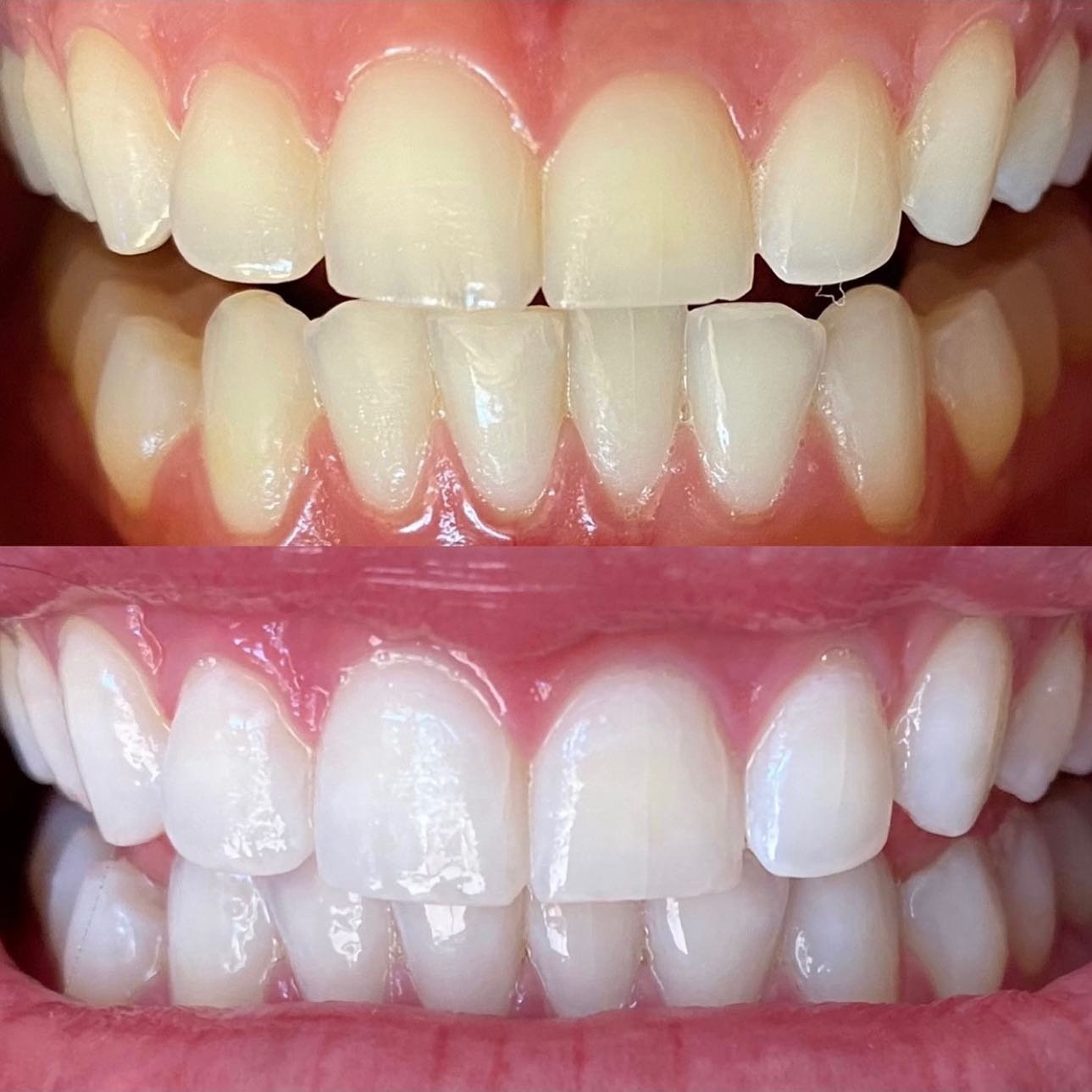 30 min Notorious Teeth Whitening at Hollywood Smiles409 Cosmetic Teeth Whitening in Beaumont, TX