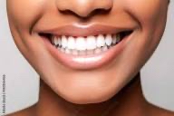 Teeth Whitening Touch Up