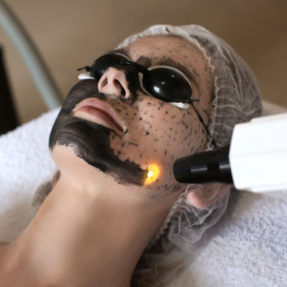 Carbon Laser at Aurora Glow Aesthetics in Spring, TX