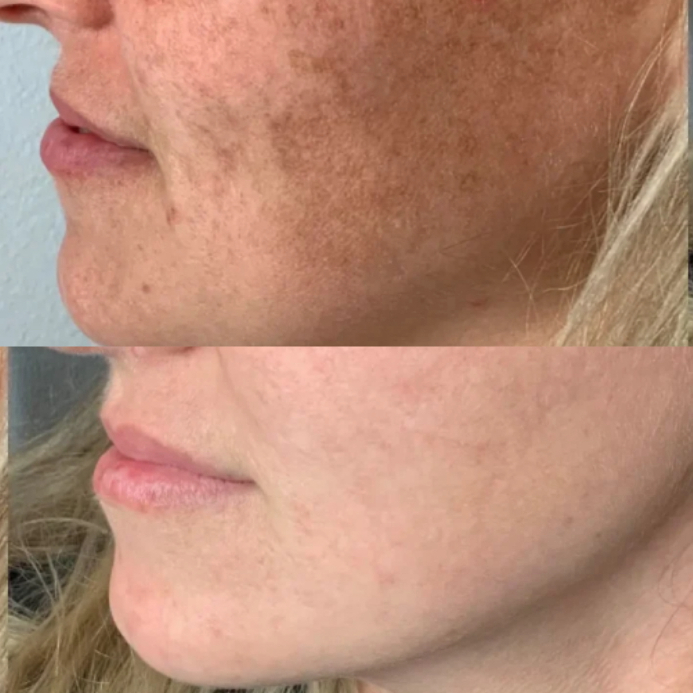 (IPL) Face at BEAUTY LAB COLLECTIVE in Miami, FL