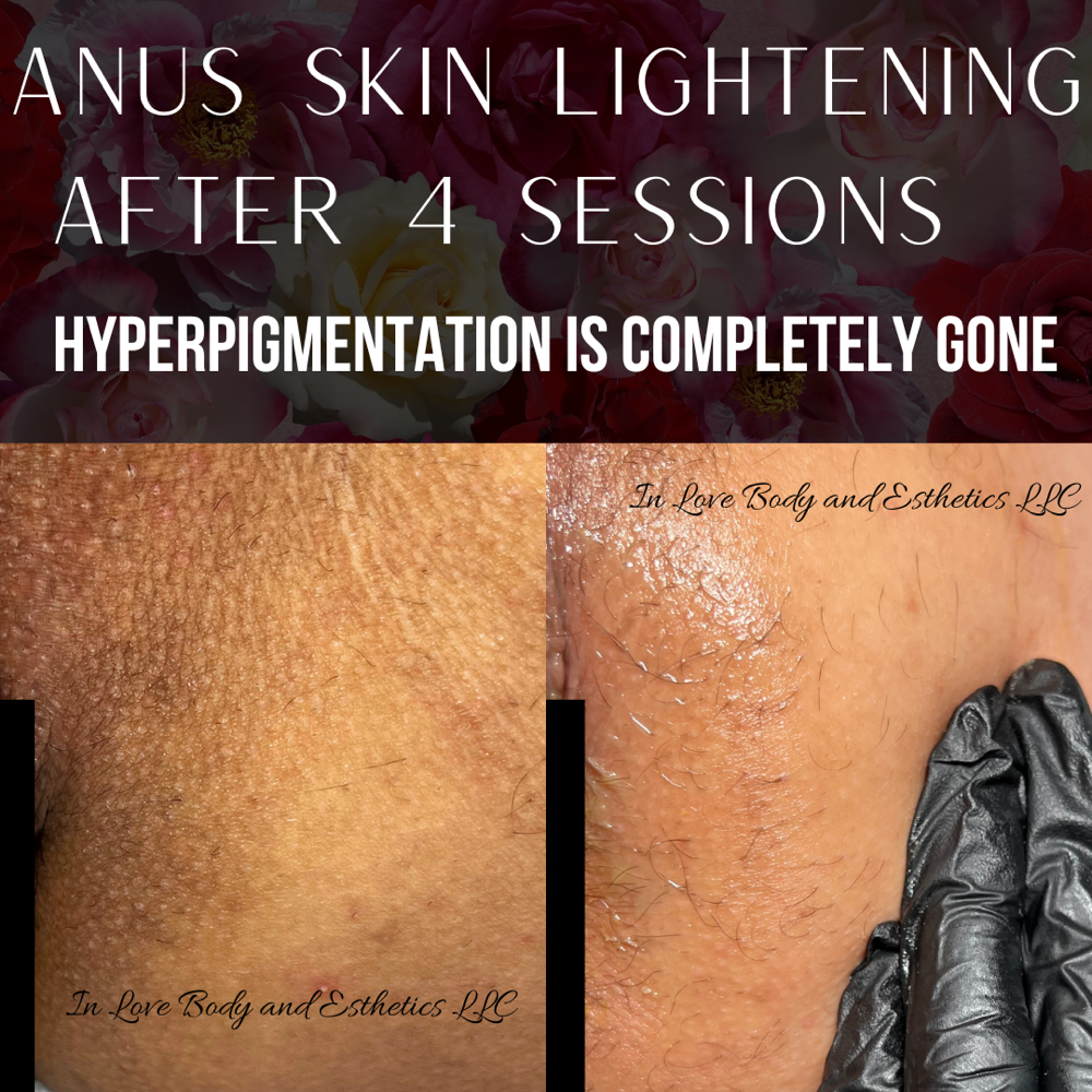 Anus Skin Correction